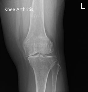 Preoperative X-ray showing AP and lateral images of the left knee