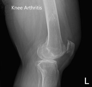 Preoperative X-ray showing AP and lateral images of the left knee - img 2