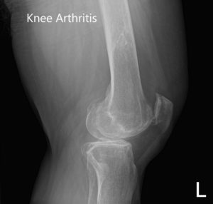 Radiografía preoperatoria que muestra AP e imágenes laterales de la rodilla izquierda - img 2