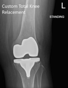 Radiografía postoperatoria que muestra AP y vista lateral de la rodilla izquierda