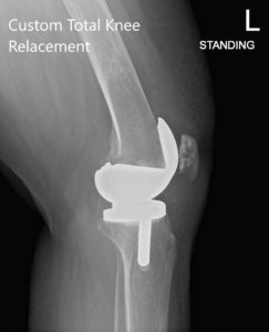 Postoperative X-ray showing AP and lateral view of the left knee - img 2