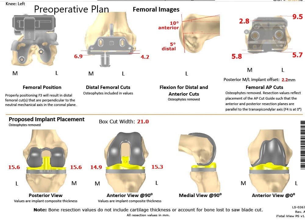 Complete Orthopedics patient specific surgical plan for Customized Total Knee Replacement in a 59-year-old male - scan 2