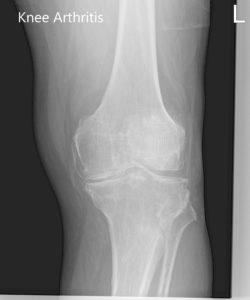 Preoperative X-ray of the left knee showing AP and lateral view of the knee with a skyline view of the patella