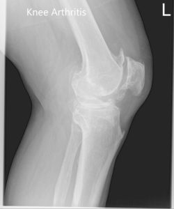 Preoperative X-ray of the left knee showing AP and lateral view of the knee with a skyline view of the patella - img 2