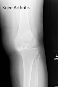 Preoperative X-ray of the left knee showing severe osteoarthritis in anteroposterior and lateral views