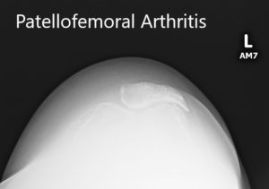 Preoperative X-ray showing the merchant view of the patella with severe patellofemoral arthritis