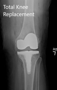 Postoperative X-ray showing the left knee joint with prosthesis in anteroposterior and lateral views