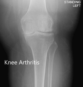 Anteroposterior and lateral view of the left knee