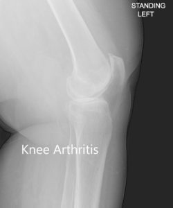 Anteroposterior and lateral view of the left knee - img 2