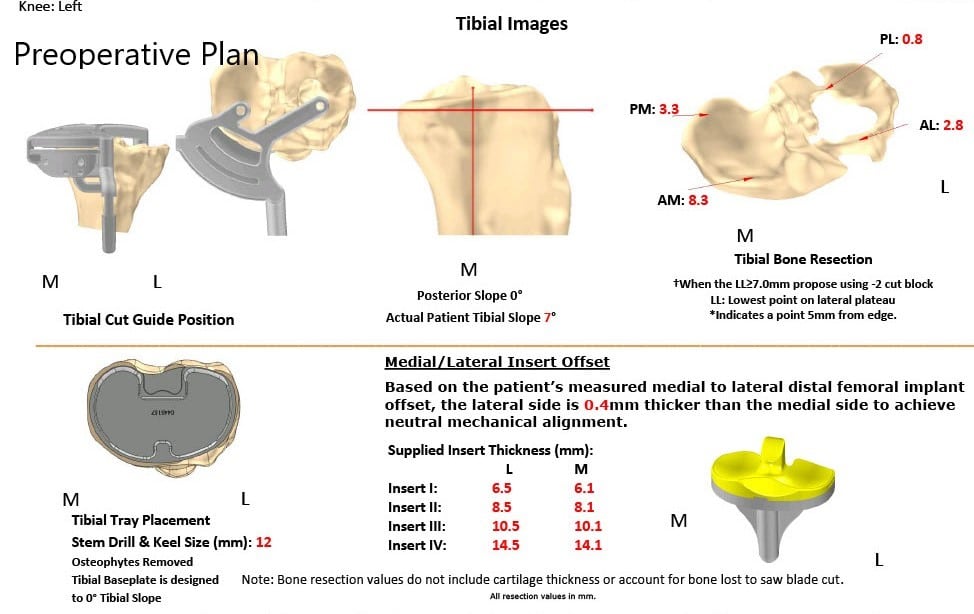 Complete Orthopedics patient specific surgical plan for a Custom Total Knee Replacement in Left Knee Arthritis with prior Hardware on the Lateral Tibial Plateau