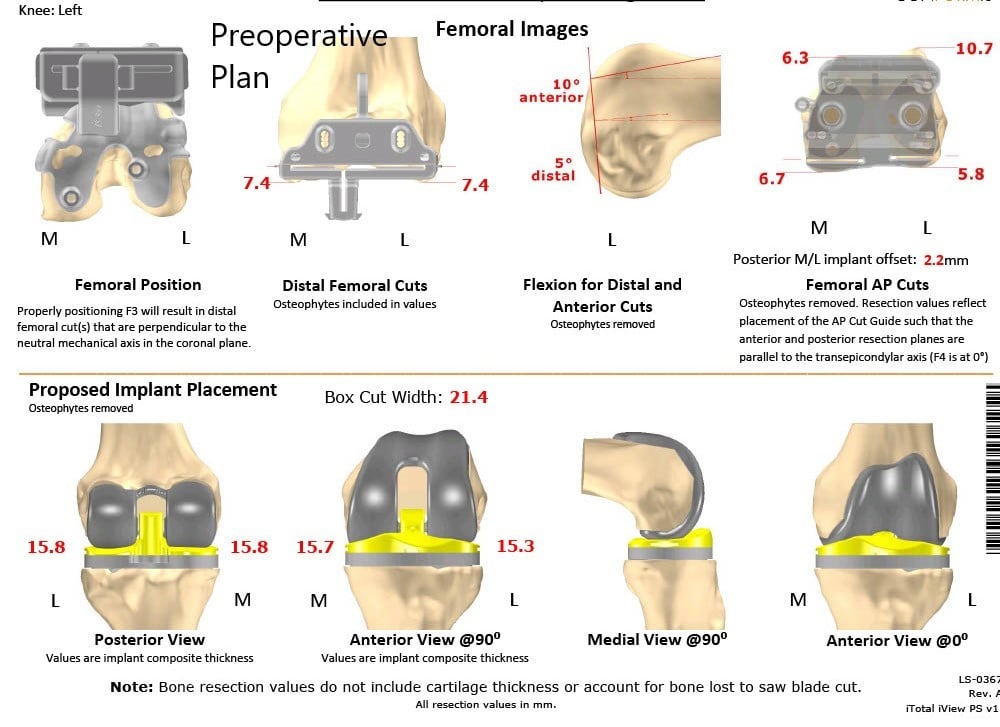 Complete Orthopedics patient specific surgical plan for a Custom Total Knee Replacement in Left Knee Arthritis with prior Hardware on the Lateral Tibial Plateau - scan 2