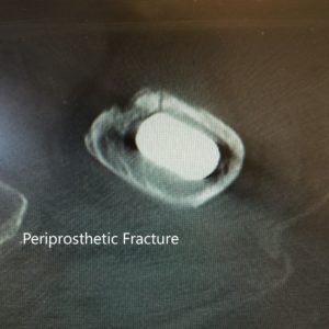 CT scan and X-ray of the left hip revealed a nondisplaced periprosthetic fracture of the proximal femur anteromedially with subsidence of the stem