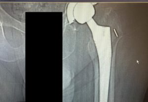 CT scan and X-ray of the left hip revealed a nondisplaced periprosthetic fracture of the proximal femur anteromedially with subsidence of the stem - img 2