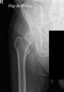 Preoperative X-ray images showing AP and frog-leg lateral view of the right hip
