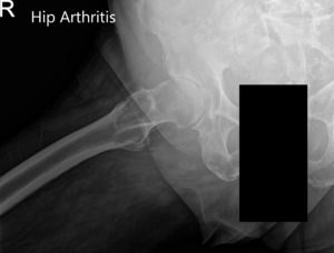 Preoperative X-ray images showing AP and frog-leg lateral view of the right hip - img 2