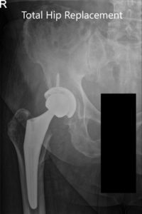 Postoperative X-ray showing AP and frog-leg lateral views of the right hip