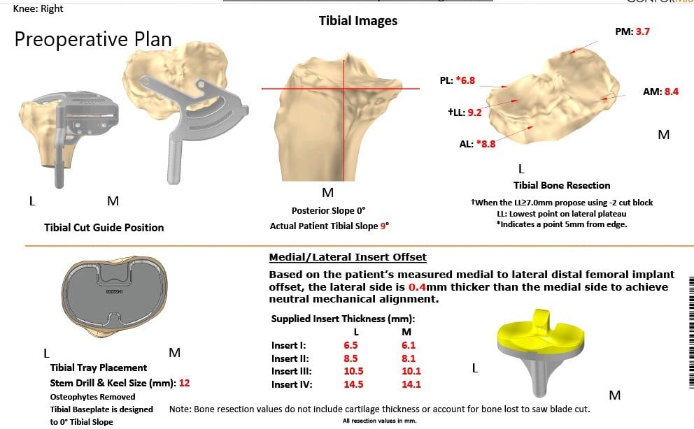 Complete Orthopedics patient specific surgical plan for a Right Knee Custom Arthroplasty in an 83-year-old male