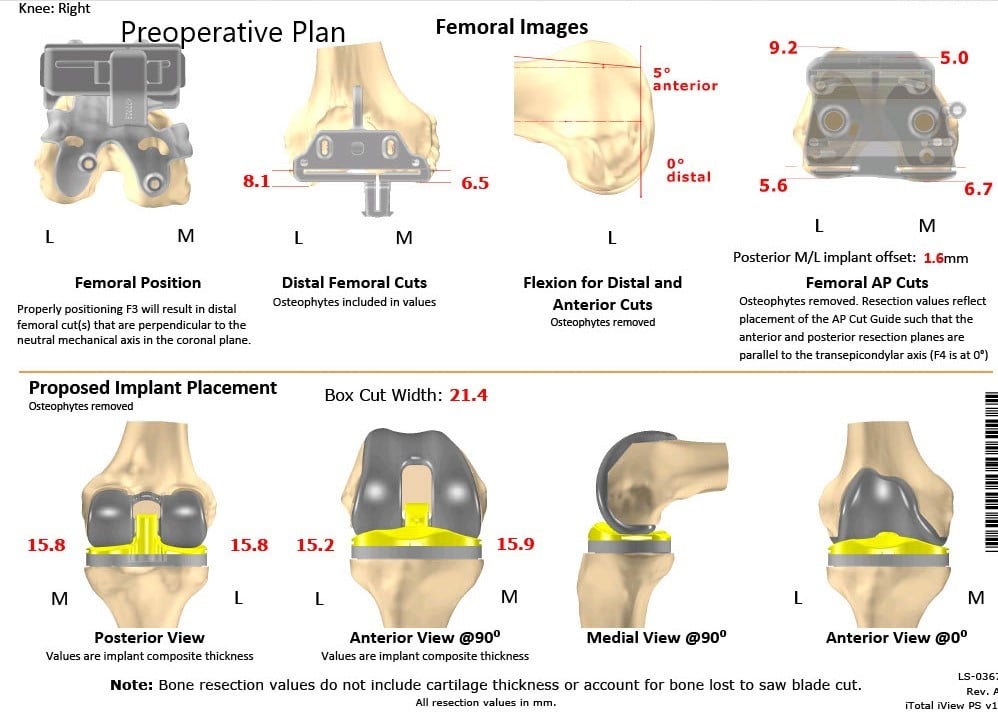 Complete Orthopedics patient specific surgical plan for a Right Knee Custom Arthroplasty in an 83-year-old male - scan 2