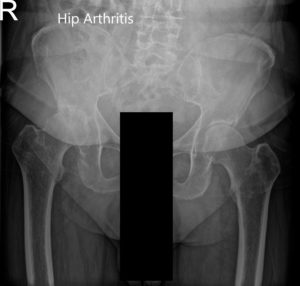 Radiografía preoperatoria de la pelvis Vista AP y vista lateral con patas de rana de la cadera derecha