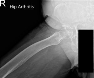 Preoperative X-ray of Pelvis AP view and frog legged lateral view of the right hip - img 2