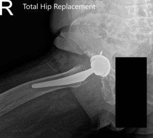 Radiografía postoperatoria que muestra la vista AP de la pelvis y la vista lateral con patas de rana de la cadera derecha.