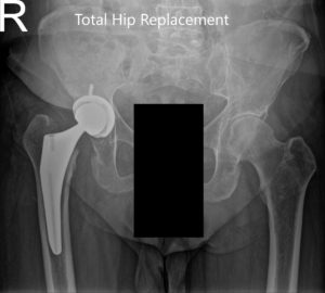 Radiografía postoperatoria que muestra la vista AP de la pelvis y la vista lateral con patas de rana de la cadera derecha - img 2