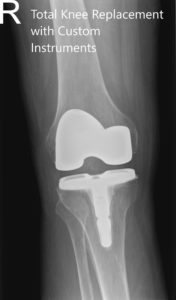 ostoperative X-ray of the right knee in anteroposterior and lateral views