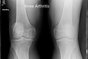 Radiografía preoperatoria de ambas rodillas en vista anteroposterior