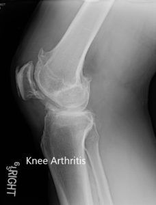 Preoperative X-ray of the right knee in lateral view and skyline view