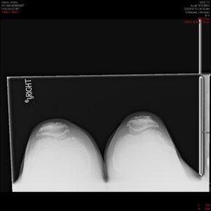 Preoperative X-ray of the right knee in lateral view and skyline view - img 2 
