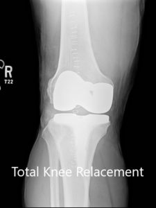 Radiografía postoperatoria de la rodilla derecha con prótesis en vistas anteroposterior y lateral