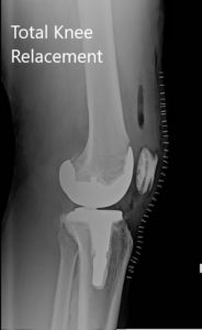 Radiografía postoperatoria de la rodilla derecha con prótesis en vistas anteroposterior y lateral - img 2  