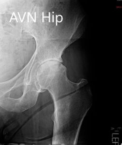 Preoperative X-ray showing the AP and the lateral views of the left hip