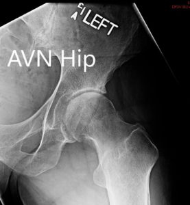 Preoperative X-ray showing the AP and the lateral views of the left hip - img 2