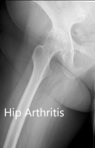 Preoperative X-ray showing the AP and the frog-legged lateral view of the right hip - img 2
