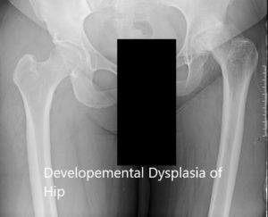 X-ray showing the AP view of the pelvis with both hip joints 