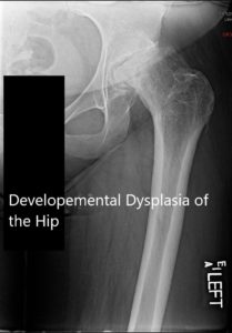 X-ray showing the AP and limited lateral view of the left hip