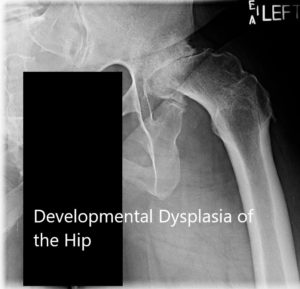X-ray showing the AP and limited lateral view of the left hip - img 2