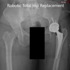 Radiografía postoperatoria de la pelvis con ambas articulaciones de la cadera en la vista AP