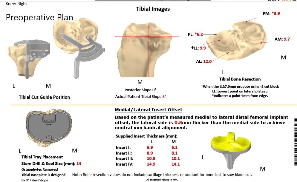 Complete Orthopedics patient specific surgical plan for a Left Custom Total Knee Arthroplasty in a 68-year-old male