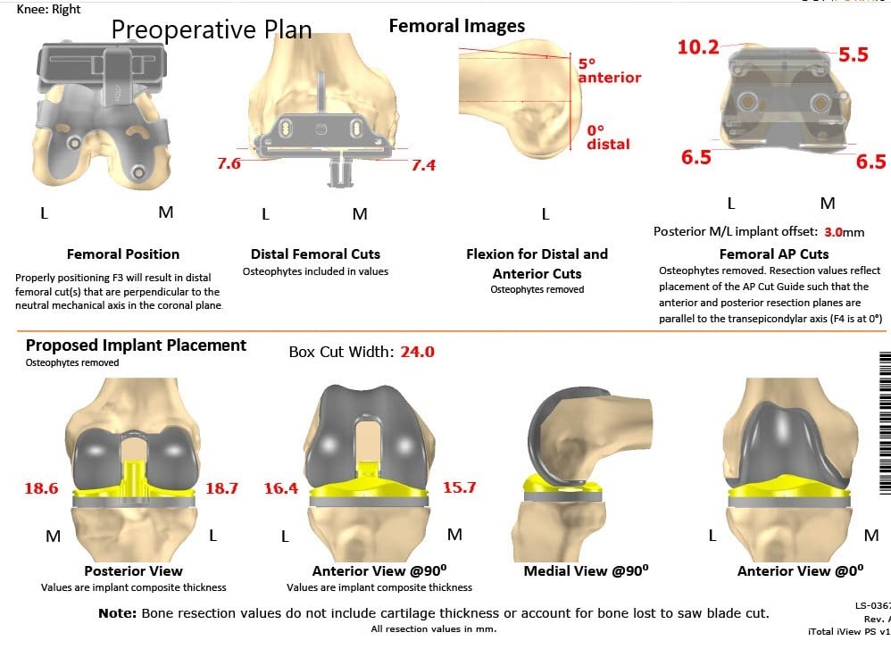 Complete Orthopedics patient specific surgical plan for a Left Custom Total Knee Arthroplasty in a 68-year-old male - scan 2
