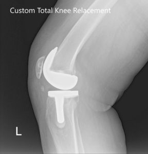 Post Operative X-Ray of the left knee showing AP and lateral view