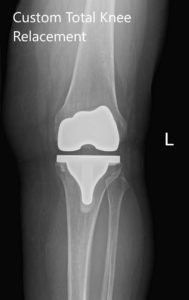 Post Operative X-Ray of the left knee showing AP and lateral view - img 2
