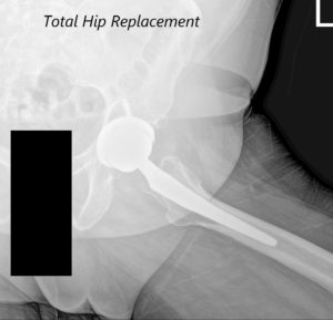Postoperative AP view of the Pelvis X-ray showing both hip joints with frog-leg lateral views of the right and left hip joints - img 3