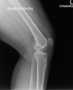Preoperative X-ray of the left knee showing AP and lateral images - img 2