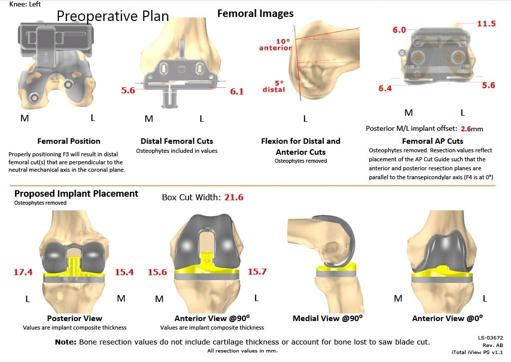 Complete Orthopedics patient specific surgical plan for a Custom Left Knee Replacement for Post-traumatic Arthritis in a 45-year-old Male - scan 2