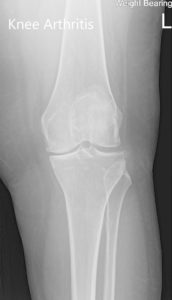 Preoperative X-ray of the left knee showing AP and lateral views