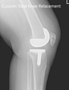 Three months postoperative X-ray of the left knee showing AP and lateral images