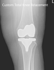 Three months postoperative X-ray of the left knee showing AP and lateral images - img 2