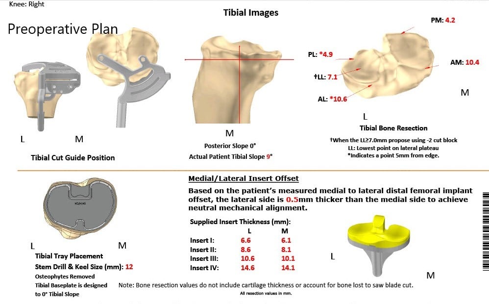 Plan quirúrgico completo de ortopedia específica para pacientes para una artroplastia total de rodilla derecha personalizada - hombre de 62 años
